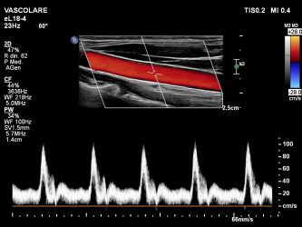 ecocolordoppler arterioso