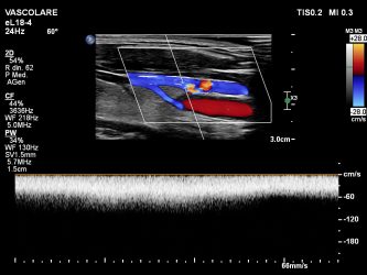 ecocolordoppler venoso