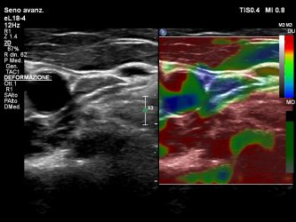 elastosonografia
