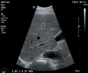 elastosonografia shear wave